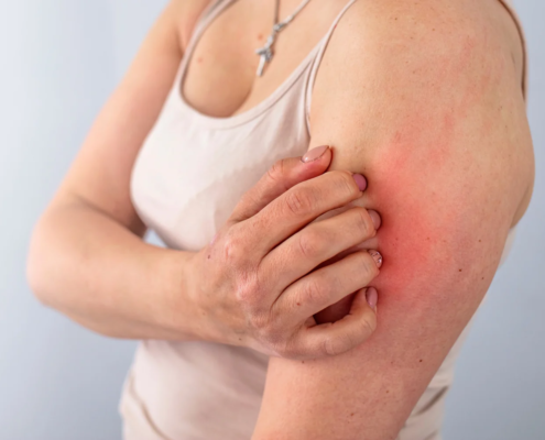 Dermatosi da stress sintomi