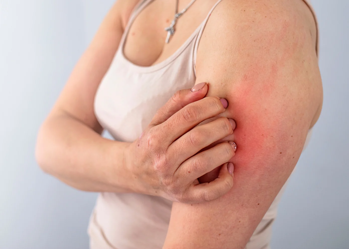 Dermatosi da stress sintomi