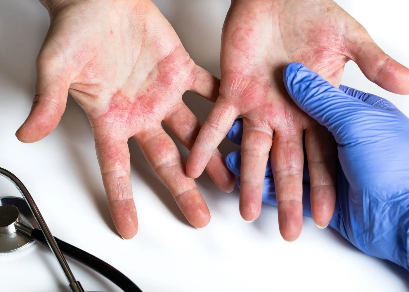 Dermatite mani da stress cause e rimedi