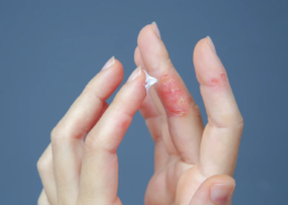 Dermatite alle mani causata da stress con arrossamento e desquamazione della pelle