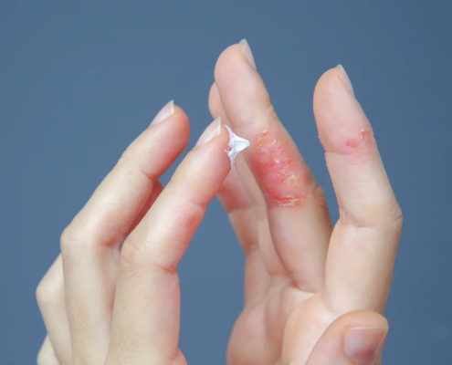 Dermatite alle mani causata da stress con arrossamento e desquamazione della pelle