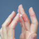 Dermatite alle mani causata da stress con arrossamento e desquamazione della pelle