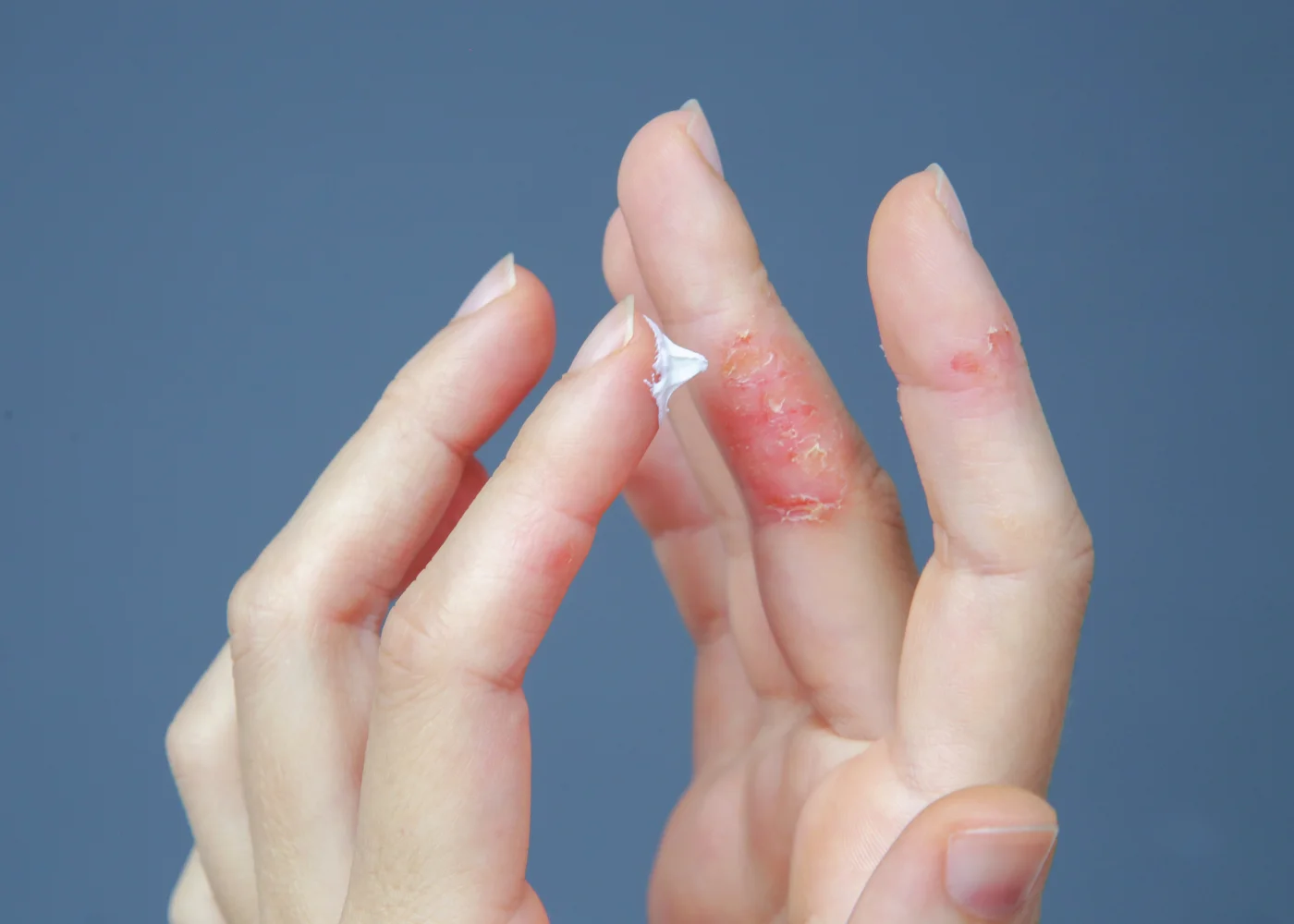 Dermatite alle mani causata da stress con arrossamento e desquamazione della pelle
