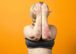 Stress e psoriasi cause