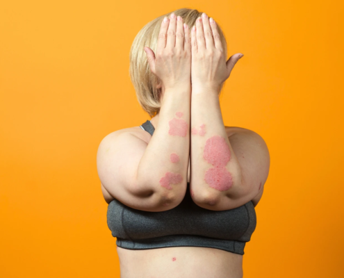 Stress e psoriasi cause