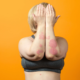 Stress e psoriasi cause