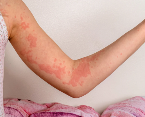 Orticaria da stress sintomi e cause