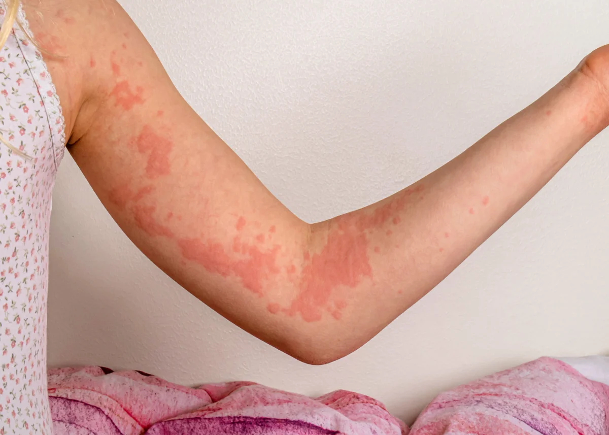 Orticaria da stress sintomi e cause
