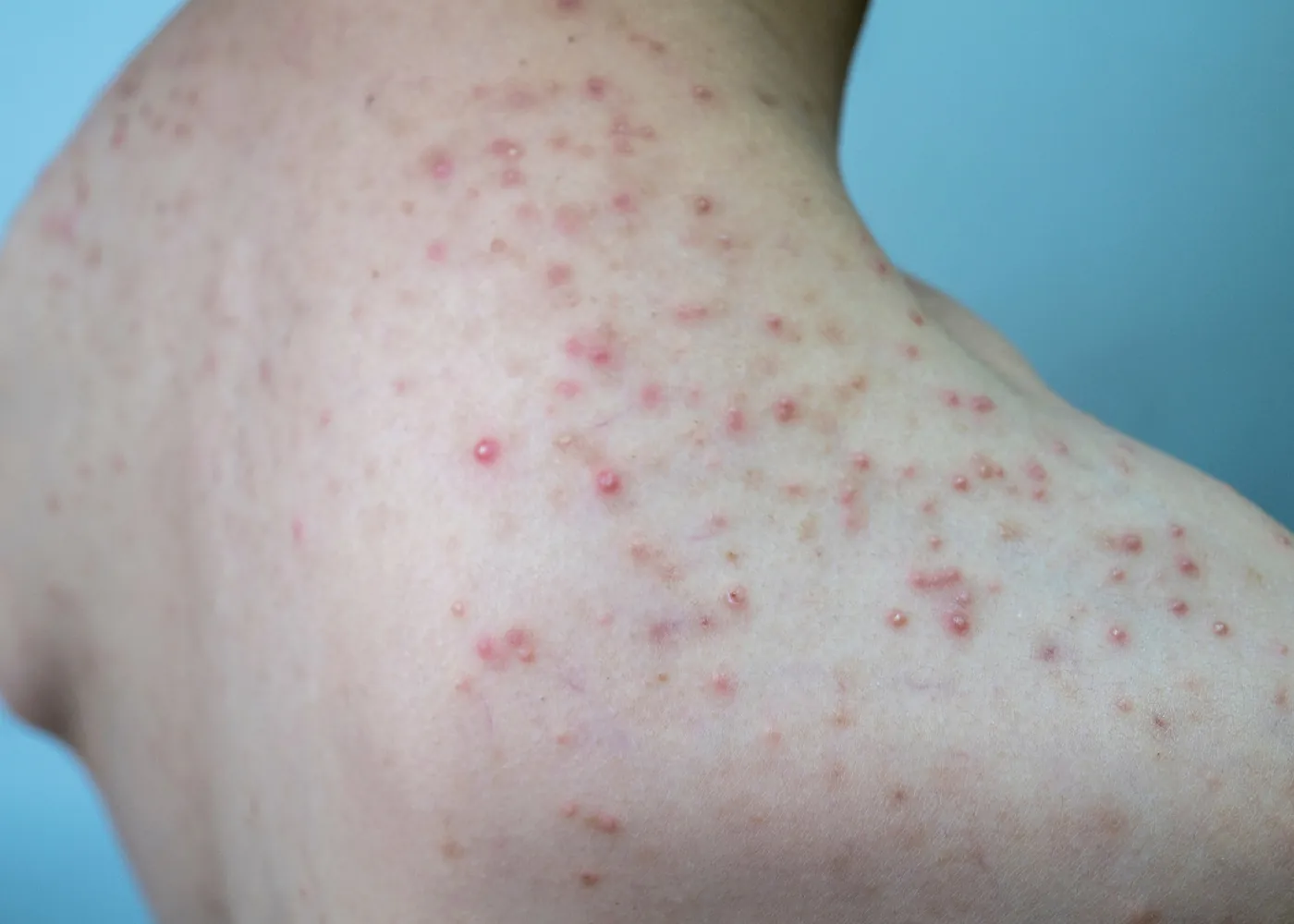 Follicolite da stress cura