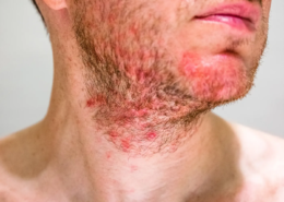 Follicolite da stress rimedi