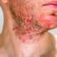 Follicolite da stress rimedi